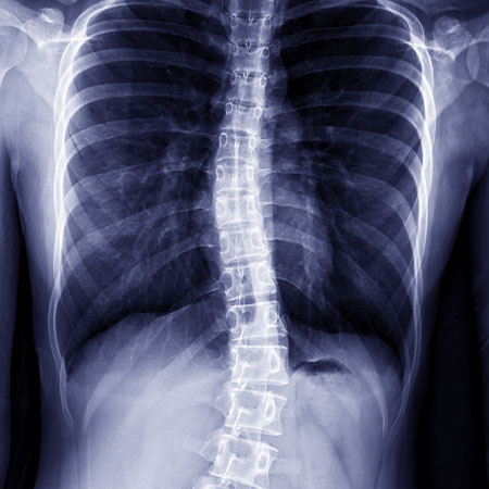 Patient suffering from scoliosis in need of chiropractor in Palo Alto